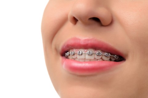 Metal Braketler