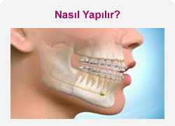ortodonti tedavisi nasıl yapılır